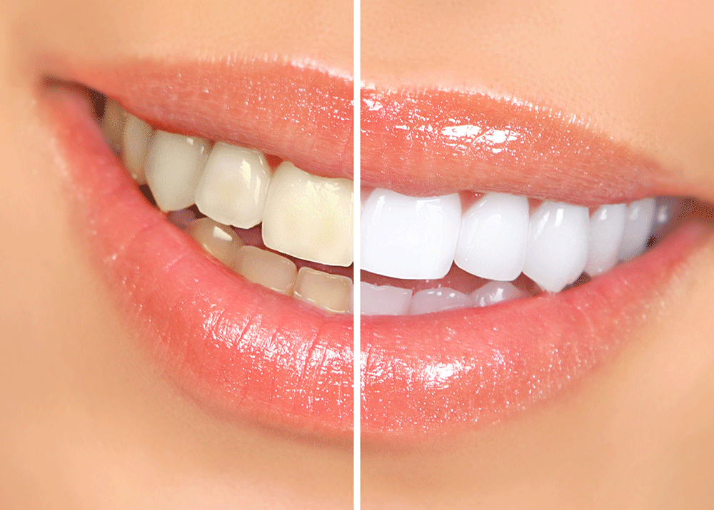 how-does-professional-teeth-whitening-work